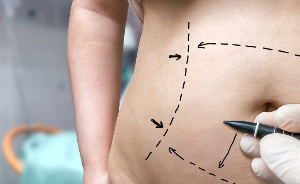 signs of a bad tummy tuck